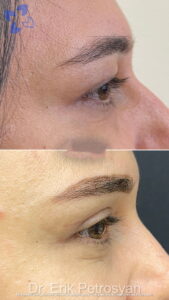 Erik Story Rhinoplasty