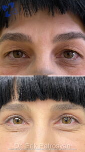 Erik Story Rhinoplasty (5)