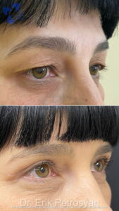 Erik Story Rhinoplasty (6)