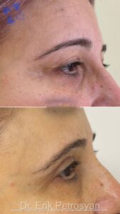 Erik StoryRhinoplasty