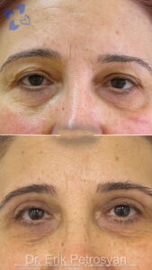 Erik StoryRhinoplasty (2)