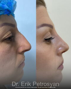 Rhinoplasty (1)