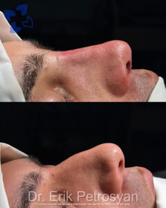 Rhinoplasty 2