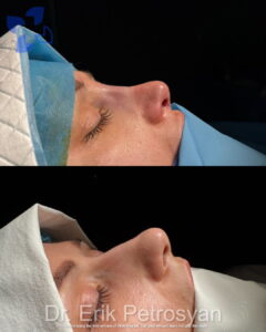 Rhinoplasty Erik Petrosyan (1)