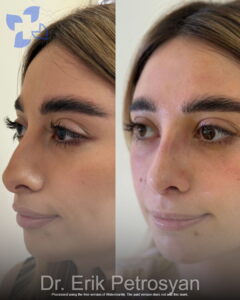 Rhinoplasty Erik Petrosyan (15)