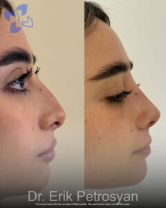 Rhinoplasty Erik Petrosyan (16)
