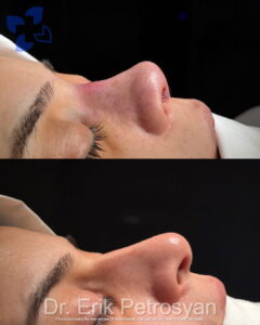 Rhinoplasty(1)