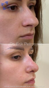 Rhinoplasty1