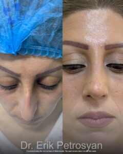 Rhinoplasty12