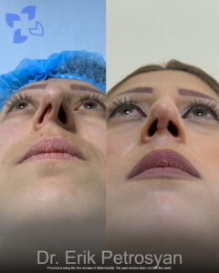 Rhinoplasty13