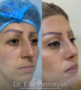 Rhinoplasty14