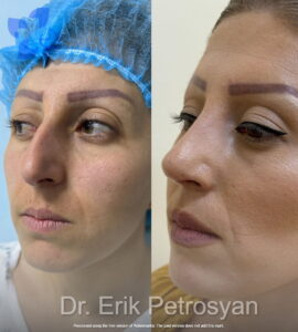Rhinoplasty15