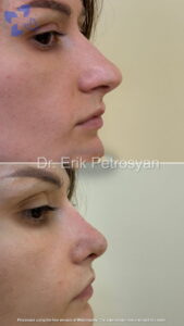 Rhinoplasty2