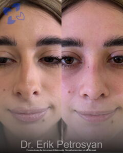Rhinoplasty21