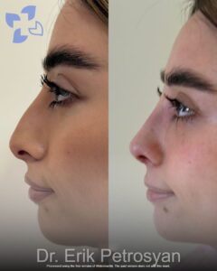 Rhinoplasty22