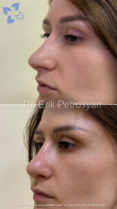 Rhinoplasty4