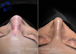 Rhinoplasty b-a Manasyan 1