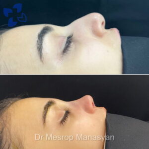 Rhinoplasty b-a Manasyan 10
