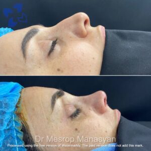 Rhinoplasty b-a Manasyan 11
