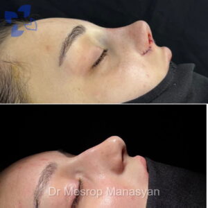 Rhinoplasty b-a Manasyan 12