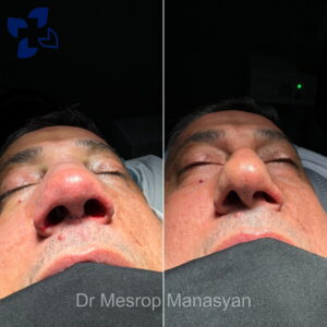 Rhinoplasty b-a Manasyan 2