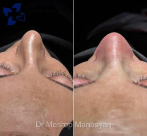 Rhinoplasty b-a Manasyan 3