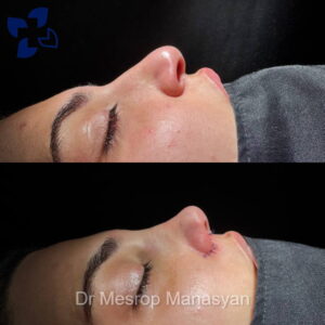 Rhinoplasty b-a Manasyan 4