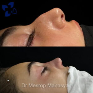 Rhinoplasty b-a Manasyan 5