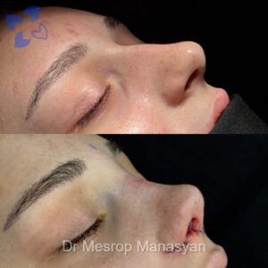 Rhinoplasty b-a Manasyan 6