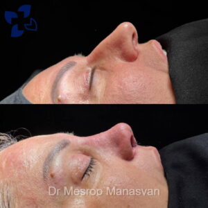 Rhinoplasty b-a Manasyan 7