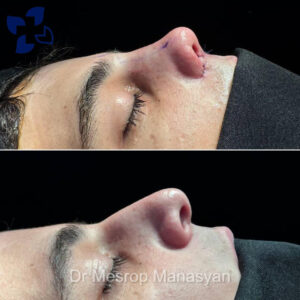 Rhinoplasty b-a Manasyan 8