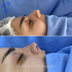 Rhinoplasty b-a Manasyan 9