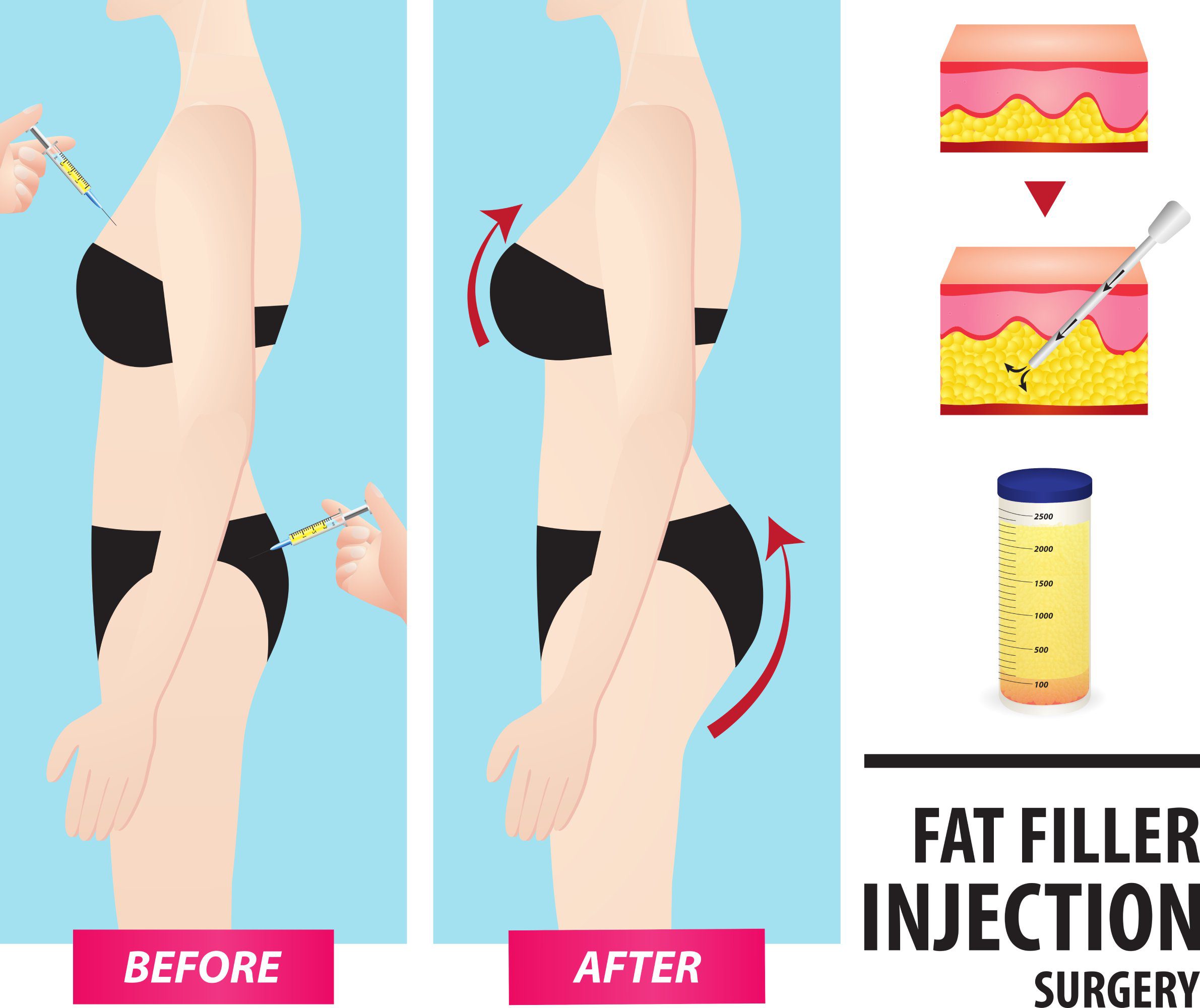 Lipofilling  Rediscover Confidence with Fat Grafting