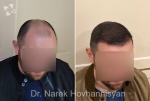 hair loss solution