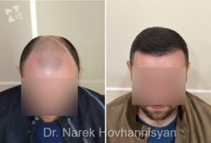 восстановление волос у мужчин