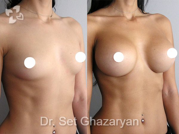 увеличение груди до и после